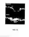 Fig. 15 - METHOD OF DETECTING OCULAR DISEASES AND PATHOLOGIC CONDITIONS AND TREATMENT OF SAME