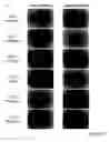 Fig. 45 - NOVEL METHOD FOR LABELLING CANCERIZATION-CAUSING CELL IN STEM CELLS, AND THERAPY METHOD