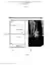 Fig. 06 - PROCESSES TO AVOID ANODIC OXIDE DELAMINATION OF ANODIZED HIGH STRENGTH ALUMINUM ALLOYS