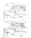 Fig. 05 - Throttle lockout with dissimilar action