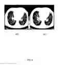 Fig. 05 - Method and system for simultaneous evaluation of airway wall density and airway wall inflammation