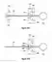 Fig. 33 - INCISION EXPANSION INTRODUCER