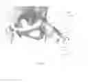 Fig. 03 - Methods and apparatus for internal hip distraction