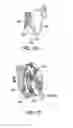 Fig. 77 - Medicant eluting adjuncts and methods of using medicant eluting adjuncts