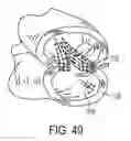 Fig. 20 - Surgical adjuncts with medicants affected by activators