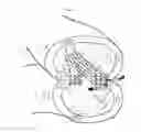 Fig. 33 - Adjunct material to promote tissue growth in a colon