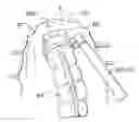 Fig. 01 - Surgical string applicator for anastomosis surgery and method of use