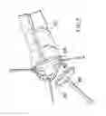 Fig. 05 - Surgical string applicator for anastomosis surgery and method of use