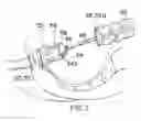 Fig. 07 - Surgical string applicator for anastomosis surgery and method of use
