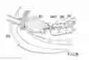 Fig. 09 - Surgical string applicator for anastomosis surgery and method of use