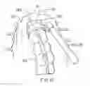 Fig. 13 - Surgical string applicator for anastomosis surgery and method of use