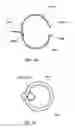 Fig. 22 - Surgical string applicator for anastomosis surgery and method of use