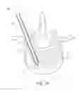Fig. 06 - Systems for treating a vertebral body