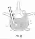 Fig. 21 - Systems for treating a vertebral body