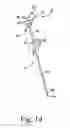 Fig. 10 - Medical instrument set and method of use for treating bony aberrations of the calcaneus