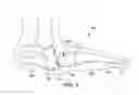 Fig. 03 - Method and cut guide for biplanar wedge osteotomy