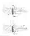 Fig. 04 - Method and cut guide for biplanar wedge osteotomy
