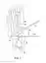 Fig. 05 - Method and cut guide for biplanar wedge osteotomy