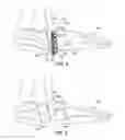 Fig. 06 - Method and cut guide for biplanar wedge osteotomy