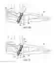 Fig. 07 - Method and cut guide for biplanar wedge osteotomy