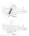 Fig. 08 - Method and cut guide for biplanar wedge osteotomy