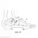 Fig. 11 - Method and cut guide for biplanar wedge osteotomy