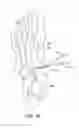 Fig. 12 - Method and cut guide for biplanar wedge osteotomy