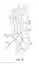 Fig. 14 - Method and cut guide for biplanar wedge osteotomy