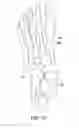 Fig. 15 - Method and cut guide for biplanar wedge osteotomy