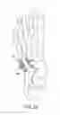 Fig. 16 - Method and cut guide for biplanar wedge osteotomy