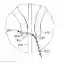 Fig. 01 - Apparatus and method to secure turbinate to nasal septum