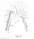 Fig. 11 - Apparatus and method to secure turbinate to nasal septum