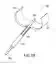 Fig. 11 - CATHETER EXTRACTION