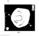 Fig. 10 - SYSTEM AND METHOD FOR ULTRASONICALLY SENSING AND ABLATING TISSUE