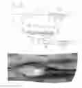 Fig. 06 - Thrombectomy devices and treatment of acute ischemic stroke with thrombus engagement