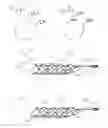 Fig. 07 - Thrombectomy devices and treatment of acute ischemic stroke with thrombus engagement