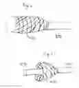 Fig. 08 - Thrombectomy devices and treatment of acute ischemic stroke with thrombus engagement