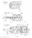 Fig. 11 - Thrombectomy devices and treatment of acute ischemic stroke with thrombus engagement