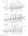 Fig. 12 - Thrombectomy devices and treatment of acute ischemic stroke with thrombus engagement