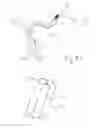Fig. 15 - Thrombectomy devices and treatment of acute ischemic stroke with thrombus engagement