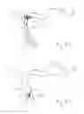 Fig. 17 - Thrombectomy devices and treatment of acute ischemic stroke with thrombus engagement