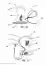 Fig. 19 - Systems and methods for tissue removal