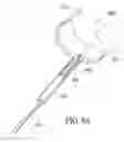 Fig. 10 - Catheter extraction