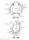 Fig. 18 - Catheter extraction