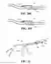 Fig. 22 - Catheter extraction