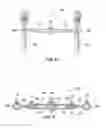 Fig. 07 - Pedicle screw having a removable rod coupling