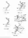 Fig. 13 - Pedicle screw having a removable rod coupling