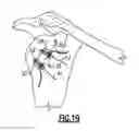Fig. 19 - Instrumentation and technique for sizing a bone reconstruction graft