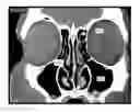 Fig. 01 - Automatic ENT surgery preplanning using a backtracking maze problem solution