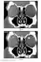 Fig. 04 - Automatic ENT surgery preplanning using a backtracking maze problem solution
